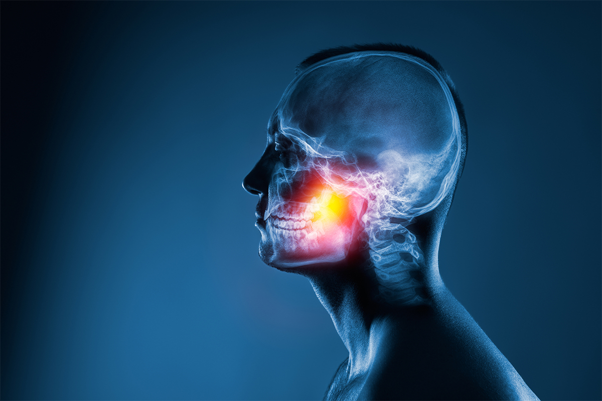 TMJ migraine image