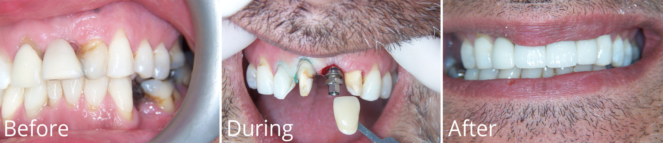 dental implants, Dental Implants
