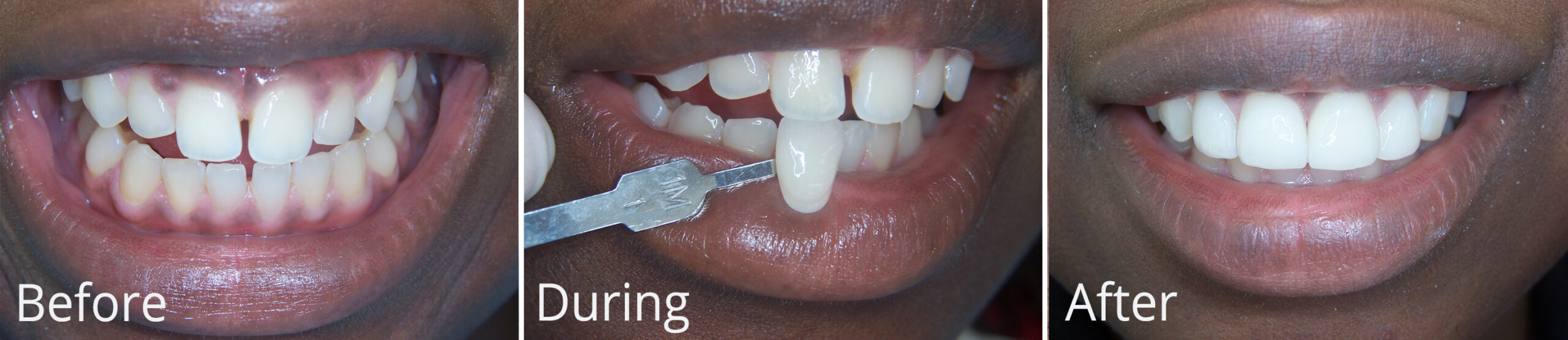 , Porcelain veneers
