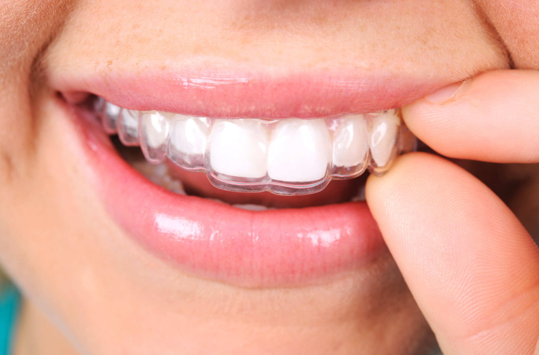 invisalign, Invisalign