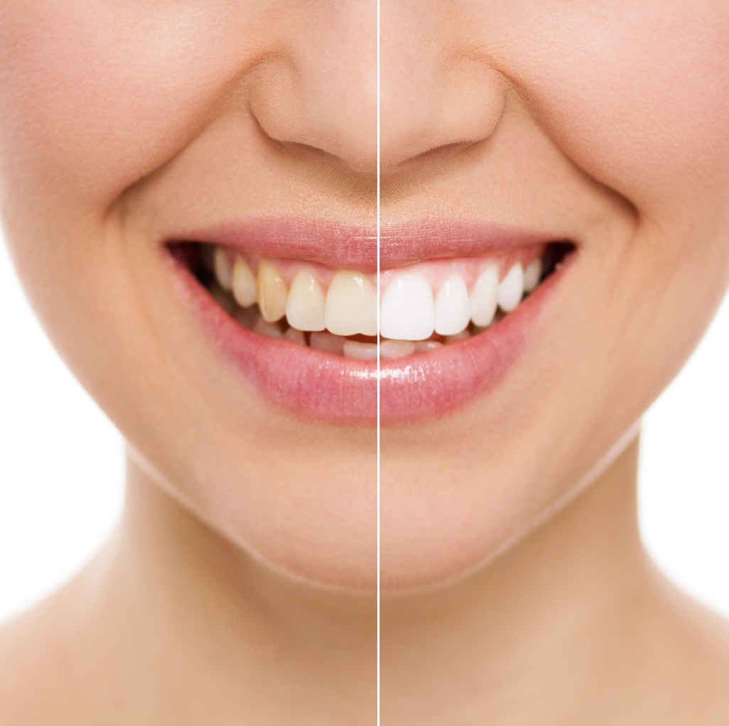 , Teeth whitening