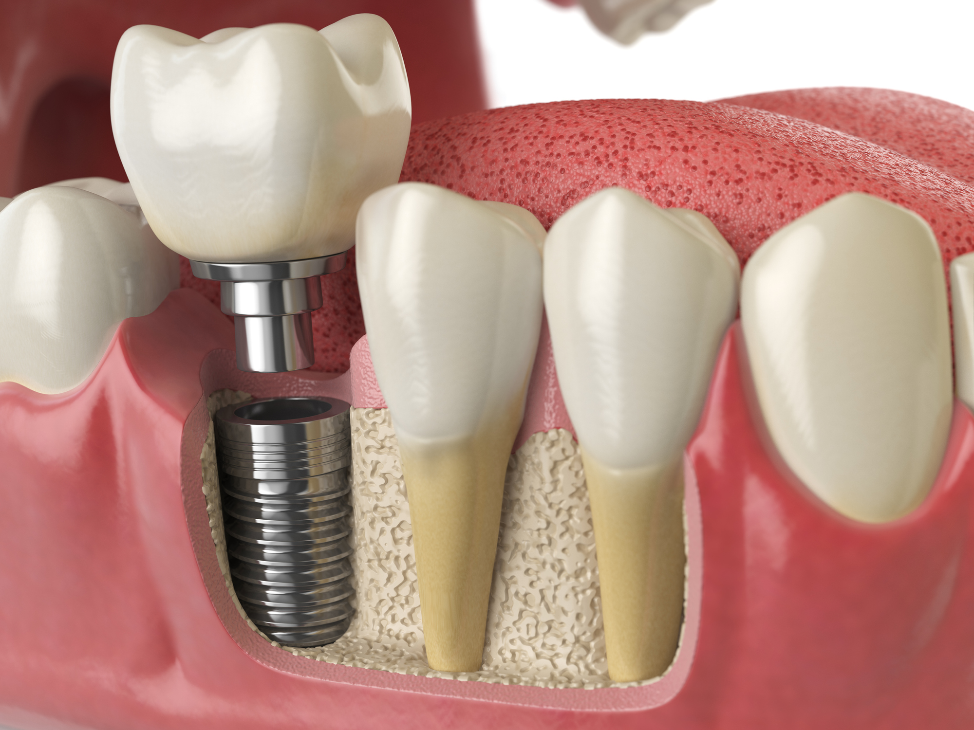 dental implants, Dental Implants